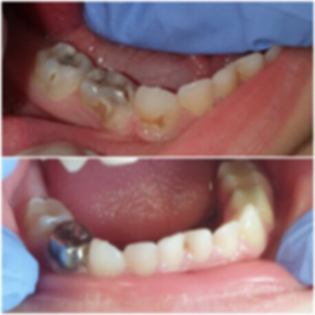 Paslanmaz Çelik Kronlar